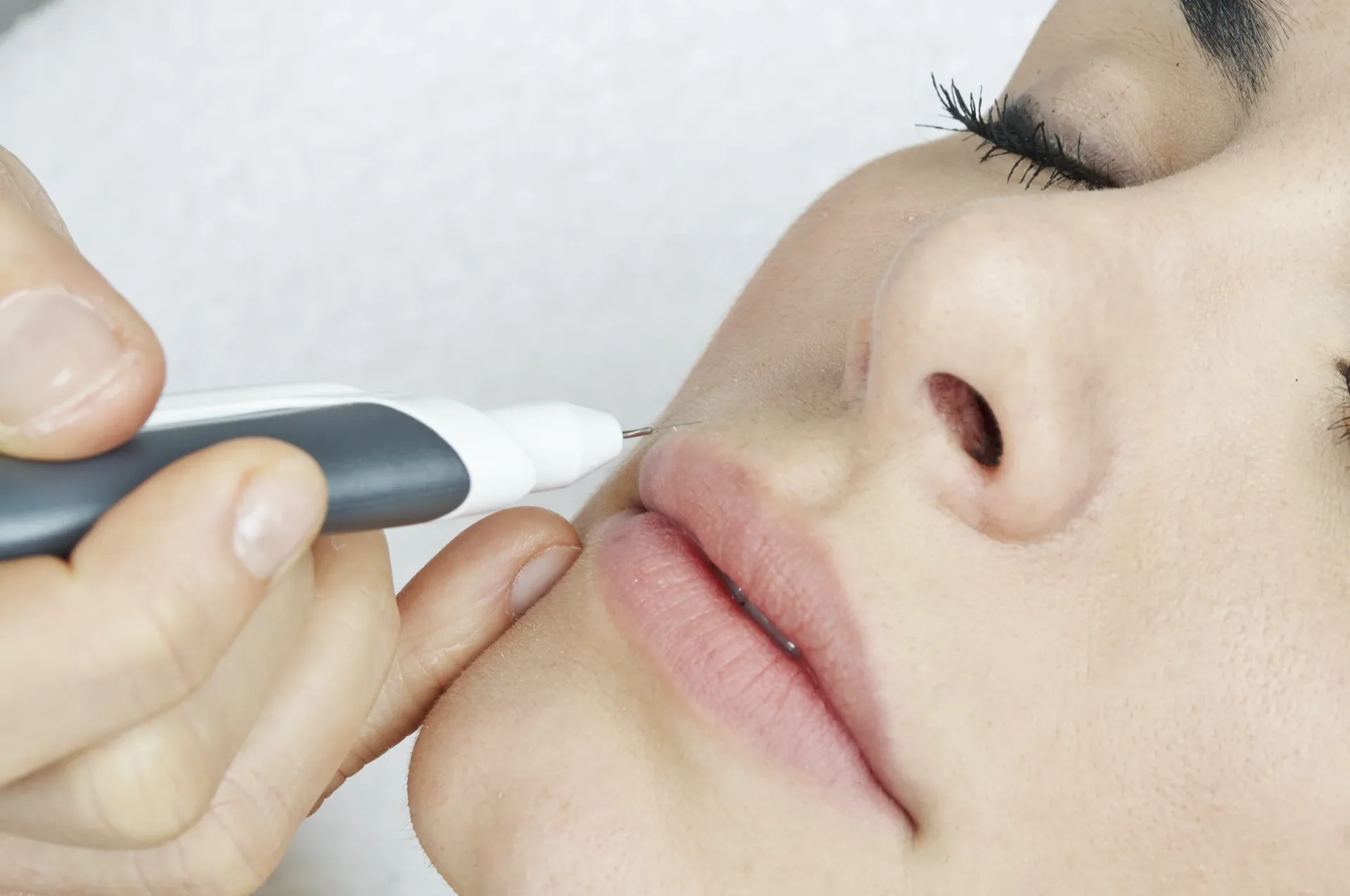 Epilation SMART